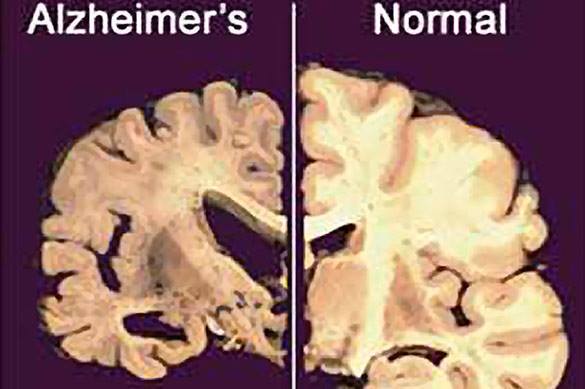 Болезнь Альцгеймера можно победить