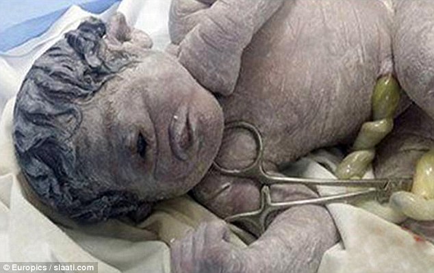 The tragic 'cyclops' baby born with one eye in the middle of his forehead