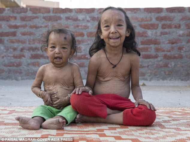 The extraordinary 'Benjamin Button' children