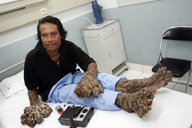 Man who suffered from limbs like TREE TRUNKS dies