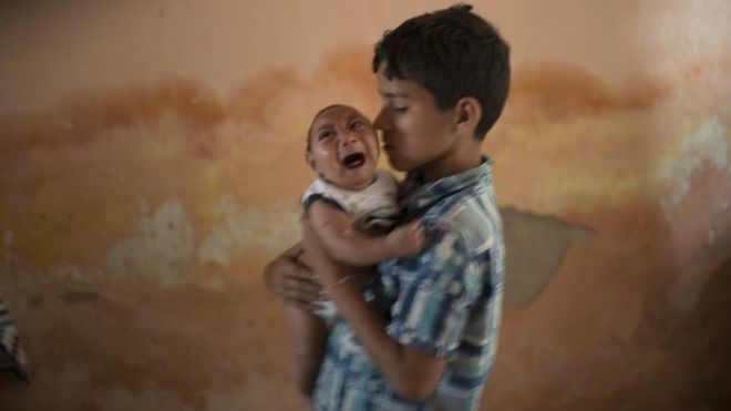 Zika virus: Study supports link to microcephaly