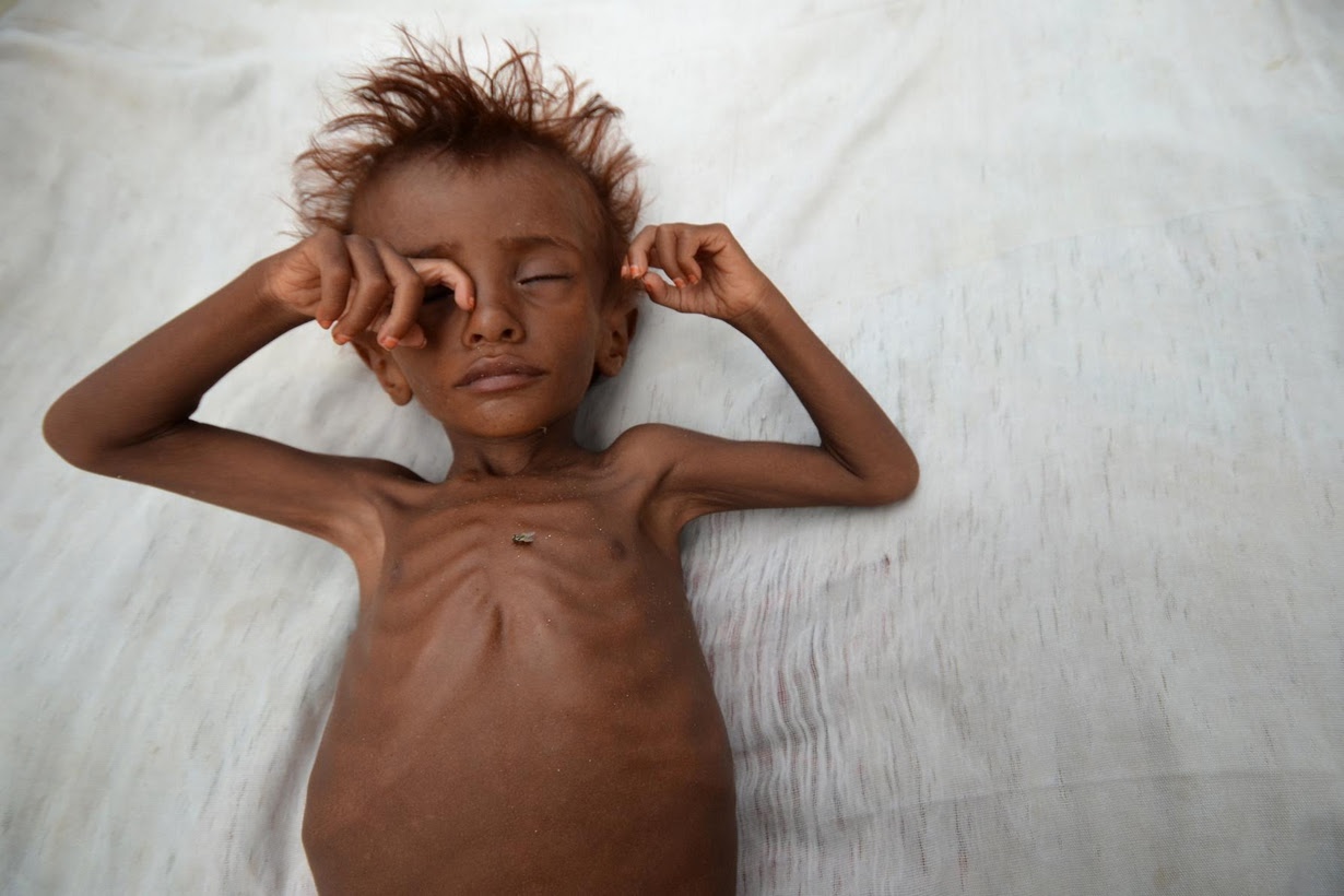Risk of famine looms in Yemen