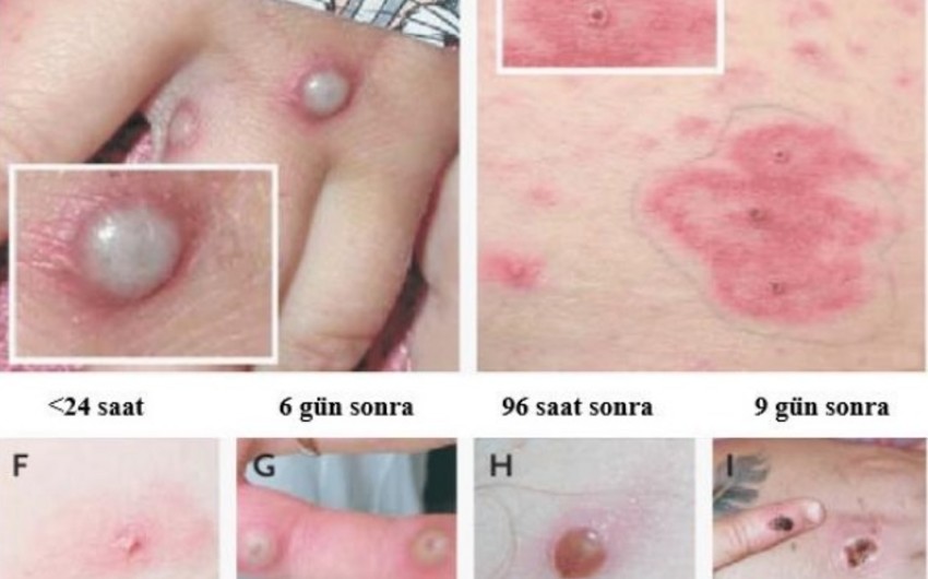 No monkeypox cases recorded in Azerbaijan - OFFICIAL