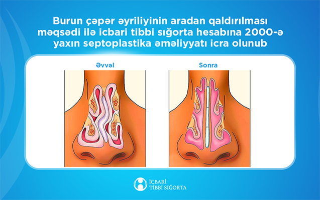 İcbari tibbi sığorta ilə 2000-ə yaxın burun çəpəri əməliyyatı icra olunub