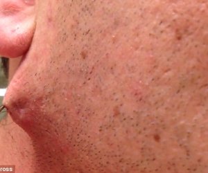 Man pulls the world's longest ingrown HAIR out of his face goes viral