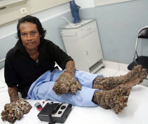 Man who suffered from limbs like TREE TRUNKS dies