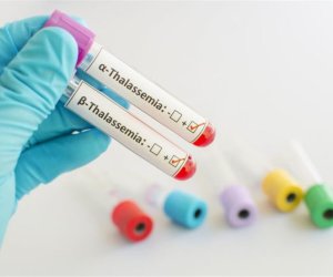 Bəzi talassemiya hallarında yeganə tam müalicə üsulu sümük iliyi transplantasiyasıdır