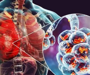 Ötən il pnevmoniyadan ölən şəxslərin sayı açıqlanıb