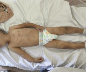 Valideynləri tərəfindən döyülən körpəsüni nəfəs aparatına qoşuldu