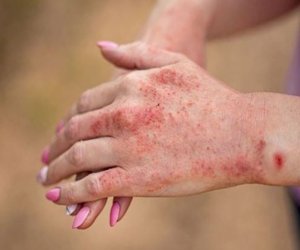 В Бангладеш от лихорадки денге за сутки умерли 12 человек