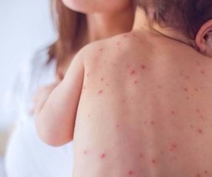 В Азербайджане зафиксировали 10 случаев кори в 2025г