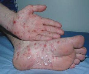Konqoda Ebola epidemiyası: yoluxanların sayı 5 656-ya çatıb
