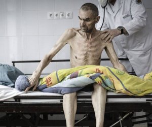Azərbaycanda qeydiyyatda olan vərəm xəstələrinin sayı 6% artıb