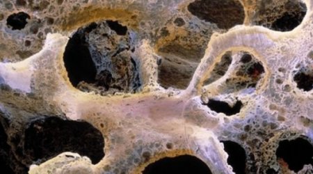 Protein could bring hope to brittle bone disease