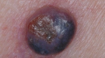 Doctors warn of aggressive form of skin cancer - PHOTO