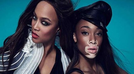 How common is skin pigment condition vitiligo?