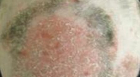 Scientists successfully use arthritis drug to regrow completely bald man's hair - PHOTO