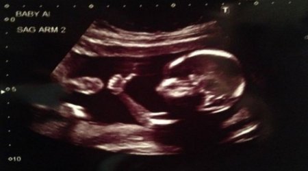 Baby gives thumbs-up in ultrasound photo