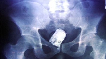 Mədəsindən əl bombası çıxdı - ŞOK FOTOLAR