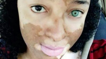 Girl born ‘with a permanent tattoo of a dog kissing a bunny’ - PHOTO