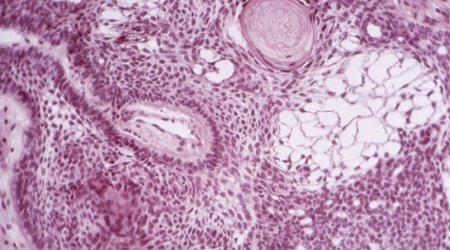 Cancer-killing stem cells engineered in lab