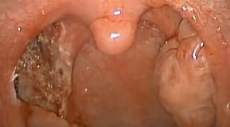 WARNING!!! Surgeon's graphic videos showing tonsils being taken out - VIDEO