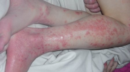 Eczema girl's agony is over - VIDEO