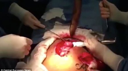 Huge LIVE fish is removed from a man's intestine - PHOTO+VIDEO