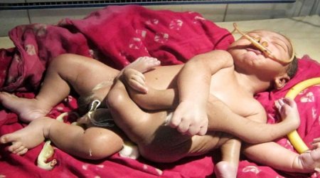 Baby born with four arms and four legs - VIDEO