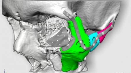 Surgeons will reconstruct road accident victim's face using 3D printing