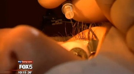 Woman gets platinum jewelry implanted in her optic membrane - PHOTO