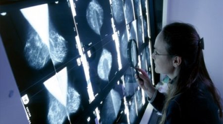 Cholesterol 'fuels' breast cancer