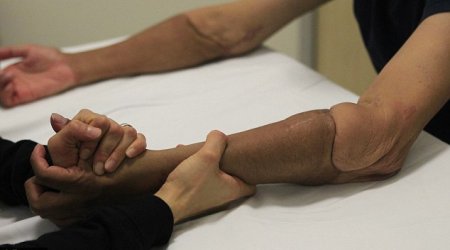 The man with two new ARMS - PHOTO