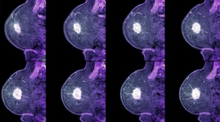 Drug 'halves' breast cancer risk