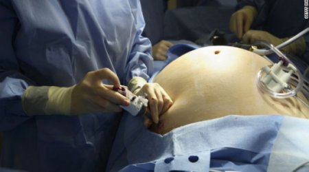 Bariatric surgery isn't 'one size fits all'