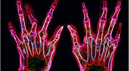 New genetic clues for rheumatoid arthritis 'cure'
