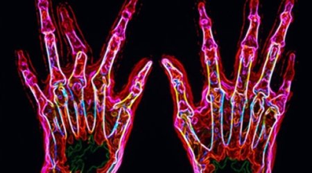 New genetic clues for arthritis