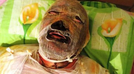 Karabakh war veteran dies of burns in hospital