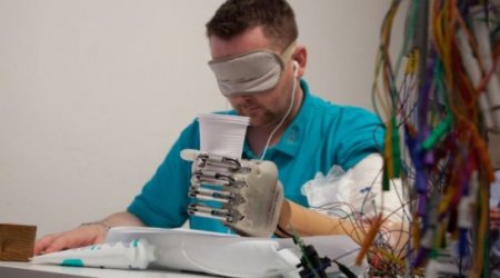 Bionic hand makes patient the first amputee in the world