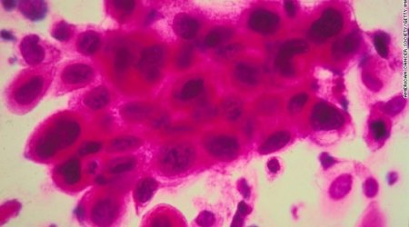 Most cancers in our world pandemic are preventable