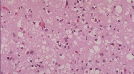 18 may have been exposed to incurable disease