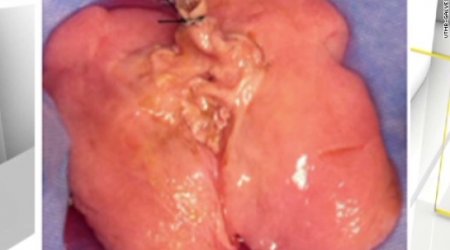 Human lung made in lab for first time