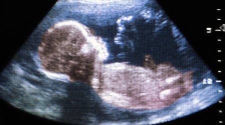 Autism may be caused by environmental factors