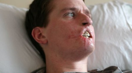 Man loses three limbs and half his face - PHOTO