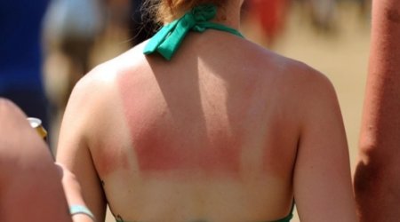 Skin cancer rates 'surge since 1970s'
