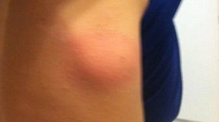 Boy\'s fatal spider bite taken - PHOTO