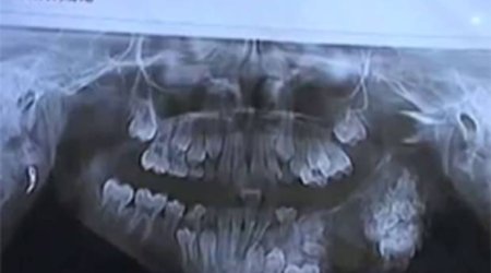 Doctors remove 80 teeth from boy's jaw