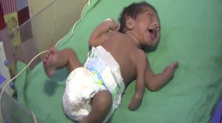 Baby born with THREE arms