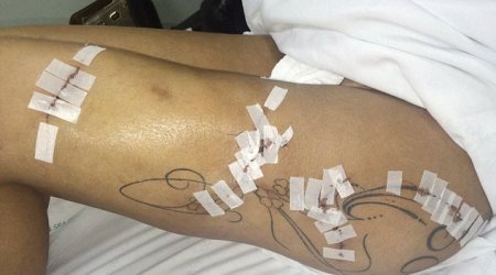 Miss BumBum contestant reveals the shocking damage caused by fillers injected