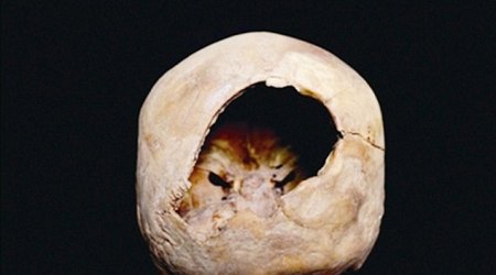Hole in skull may have been created by craniotomy